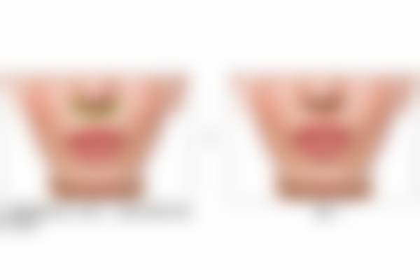 北京蕾士悦容医疗美容门诊部赵妍医生做双眼皮的五大突出理由