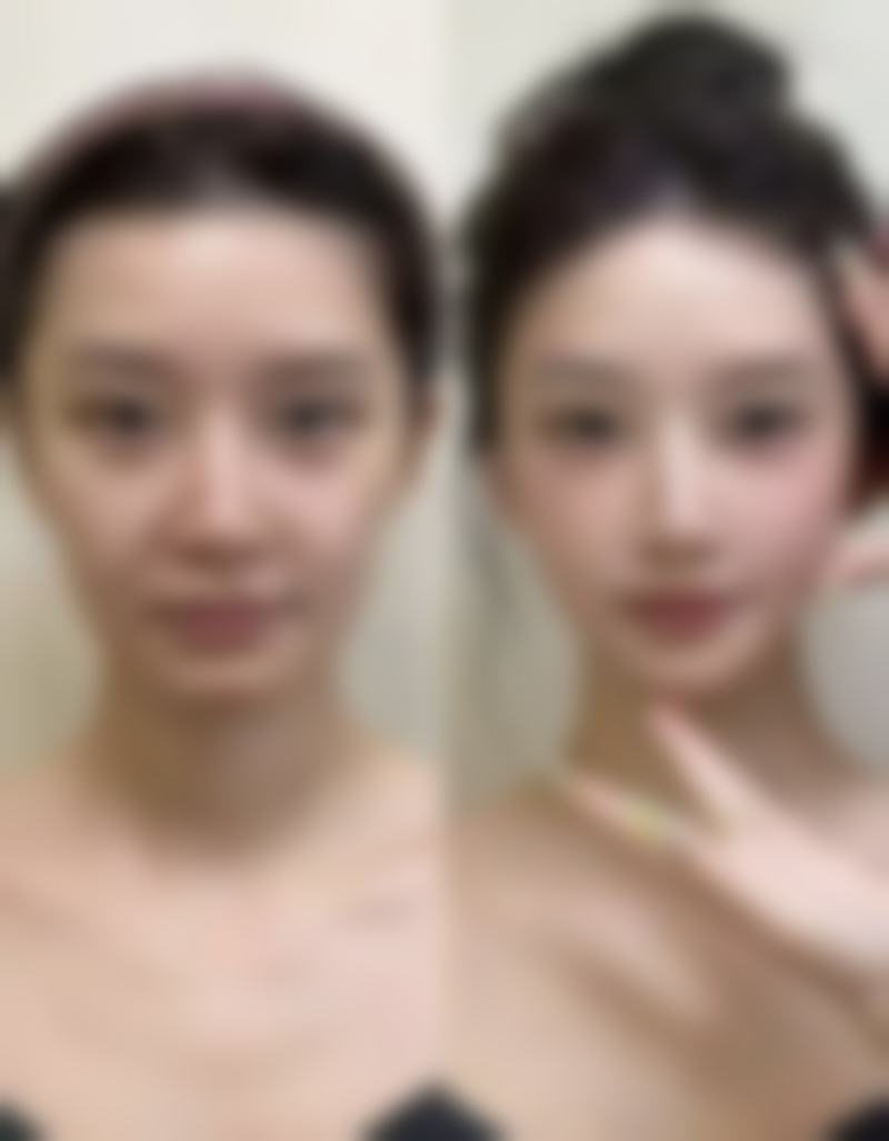 韩国21整形外科怎么样,实际手术实例