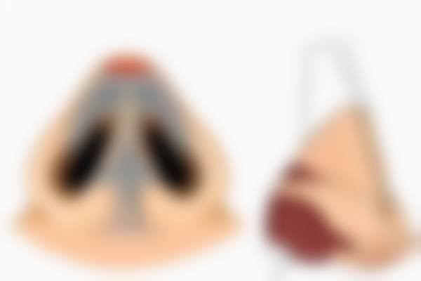 无痕人中缩短术：开启面部年轻化之旅