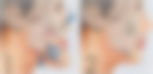 杨凡医生做手术价格