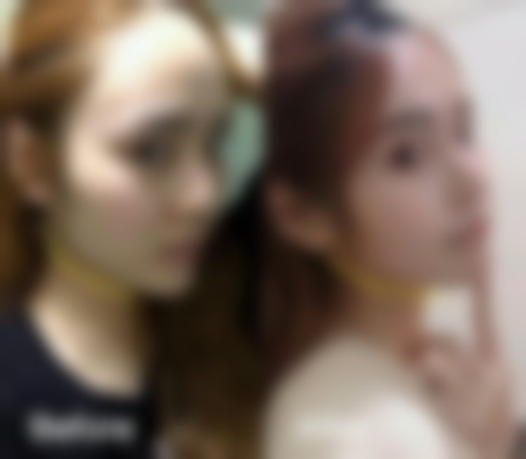 12800元享杭州连天美医疗美容医院时代天使牙齿隐形矫正套餐顾客实例