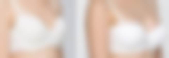 嗨体打颈纹成效:见证天生深颈纹的逆袭