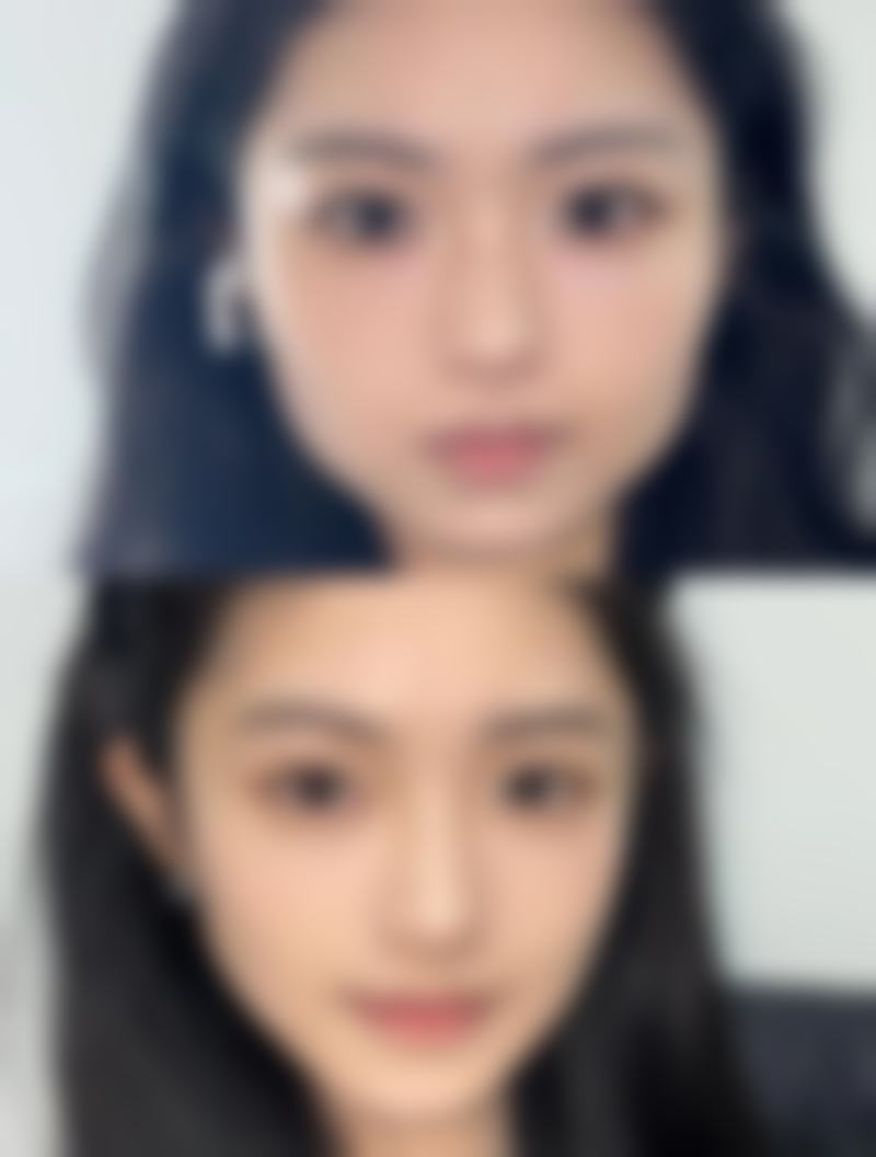 疤痕预防与护理指南