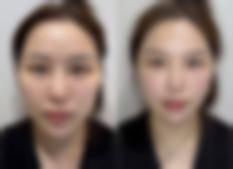 武汉顿兆医生双眼皮修复——可靠的双眼皮修复技术
