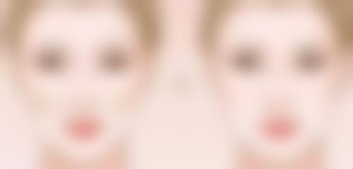 埋线双眼皮以后取线吗——北京丽星翼美