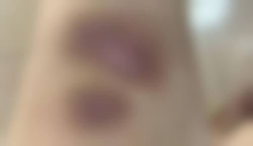 怎么去除黑的疤痕——福州玛恩皮肤医疗美容门诊部