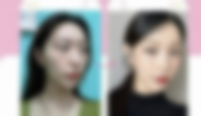 埋线双眼皮以后取线吗——北京正美