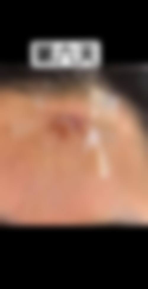 中医怎么治疗疤痕疙瘩——杭州肤康皮肤病医院