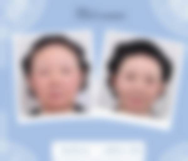 韩国THE整形外科韩国the整形外科案 例