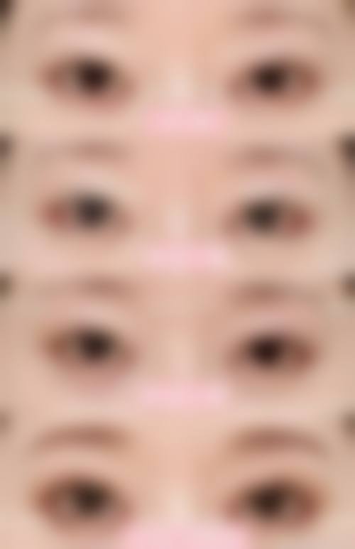 埋线双眼皮能管多少年？李燕医师技术+术后护理定维持时长范围