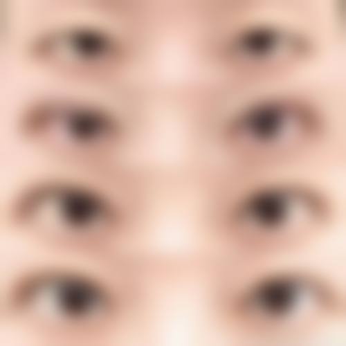 埋线双眼皮能管多少年——北京客来美舍