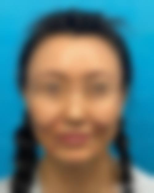 40岁女人眼袋怎么去——杭州华 山连天美整形医院