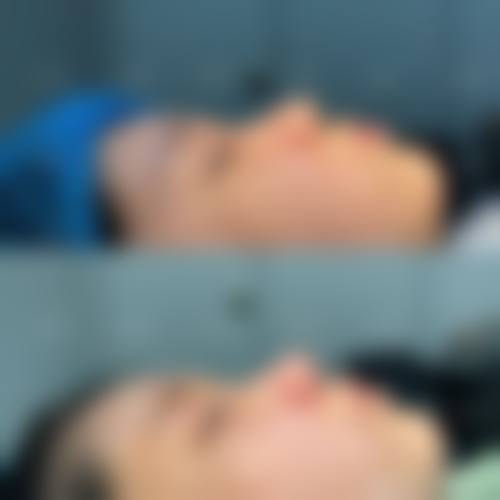 隆鼻碰到了会怎么样——北京华韩医疗美容医院