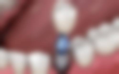 优惠活动详情：高性价比口腔护理方案