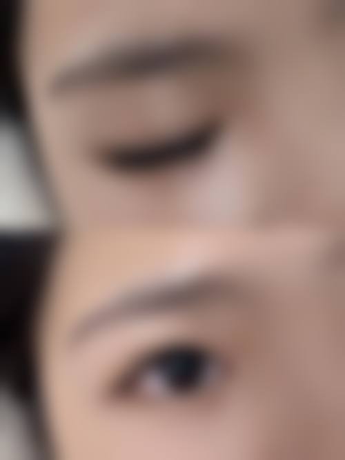 有治疗凹陷疤痕成功的吗——长沙核美丽医疗美容门诊部