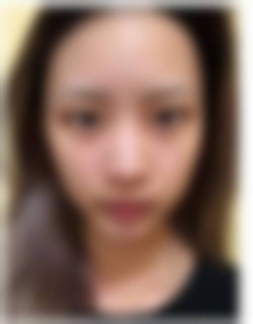 隆鼻碰到了会怎么样——太原军大医疗美容医院