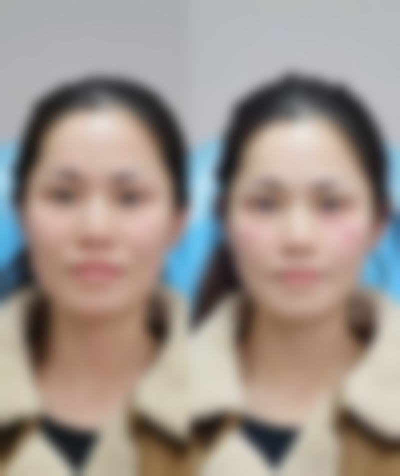隆鼻碰到了会怎么样——郑州天后整形医院