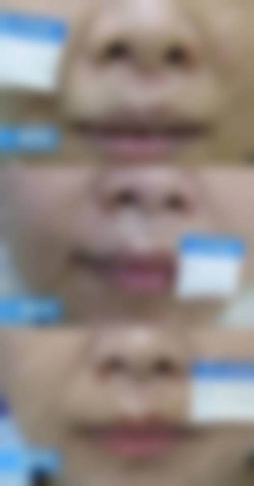 开水烫伤疤痕消除——中南大学湘雅三医院