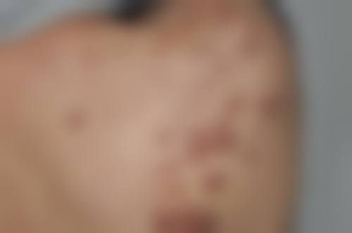 如何才能消掉疤痕体质——首都医 科 大学附属北京友谊医院