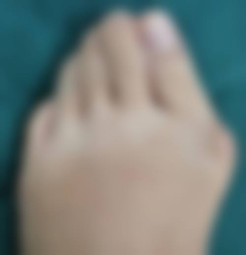 割双眼皮能吃蘑菇类吗——北京积水潭医院