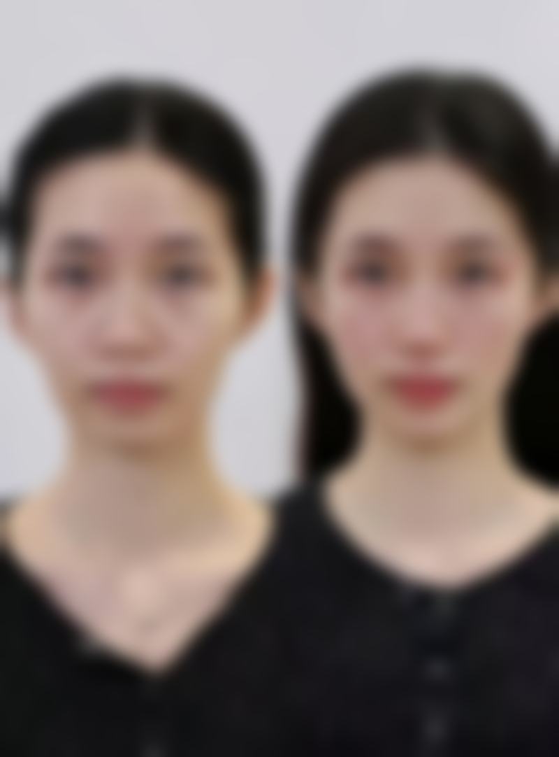 补充胶原蛋白可以去眼袋吗？医美胶原填充见效快，日常食补可辅助