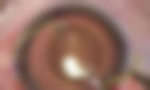 擅长项目详解 盐城市第三人民医院眼科 蔡如远 近视手术