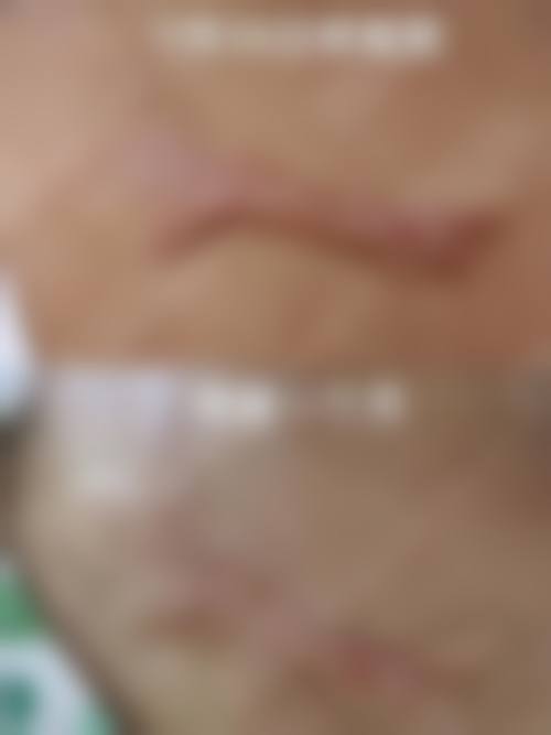 割完双眼皮的红色疤痕什么时候能消？3月近肤色，6月可修复