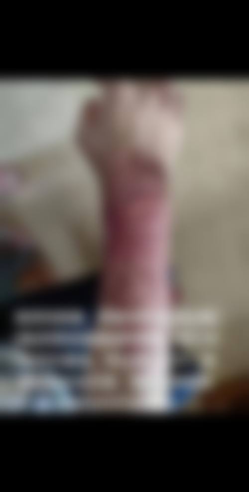 烫伤疤痕十几年了可以修复吗——上海健桥医院