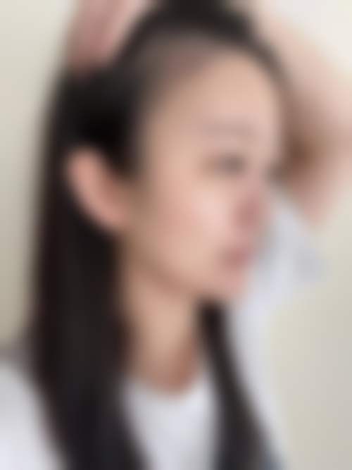 15000预算在扬州俏华美医疗美容诊所打艾莉薇风尚的顾客实例