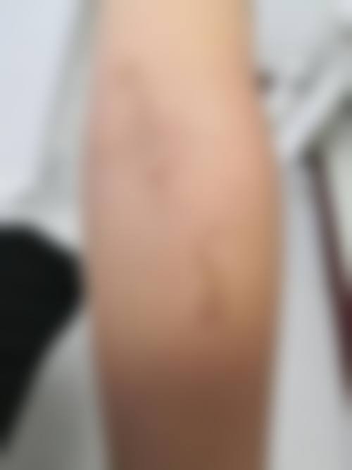 疤痕疙瘩怎么修复较好——上海清沁疤痕修复中 心