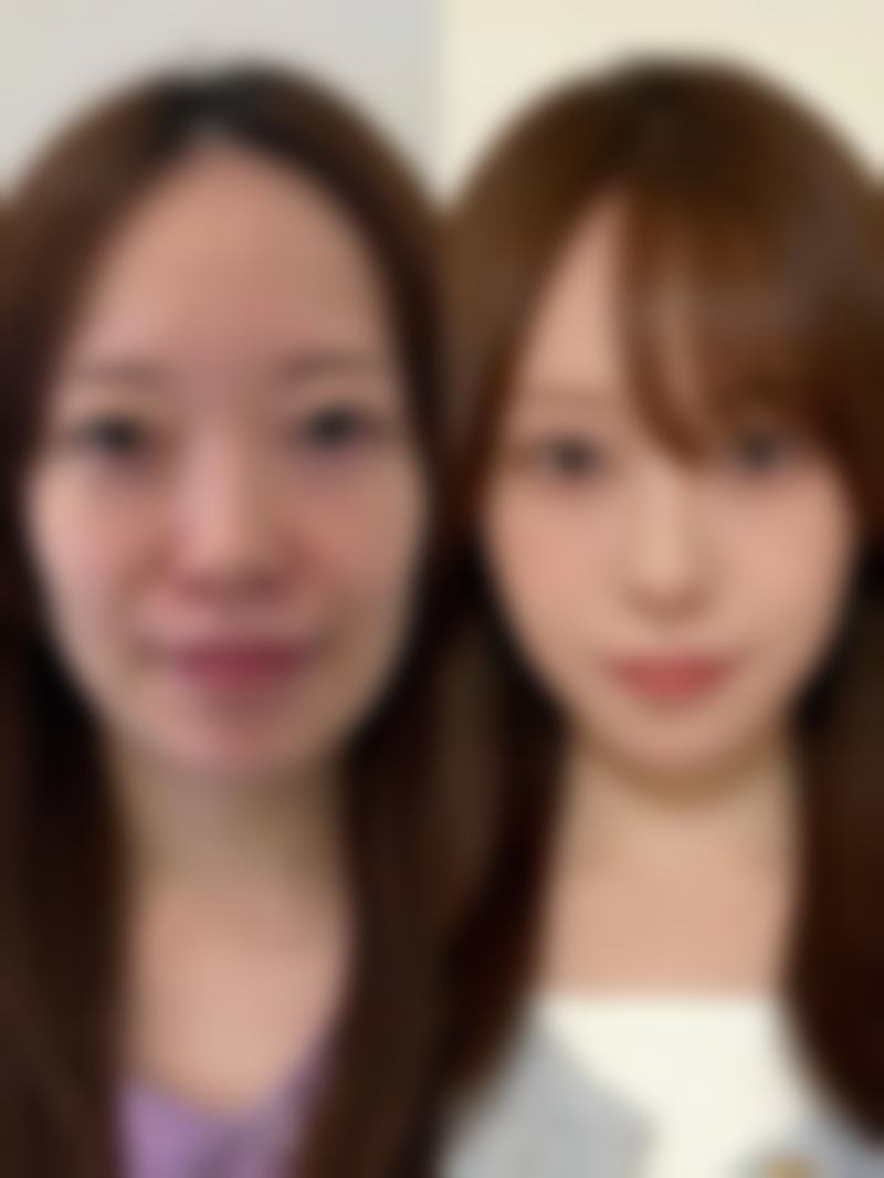 去眼袋用什么方法至佳——山东省立医院